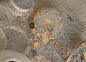 برای نخستین بار در شهر سوخته یك چشم مصنوعی متعلق به 4800 سال پیش كشف شد. این چشم مصنوعی متعلق به زنی 25 تا 30 ساله بوده که در یکی از گور های شهر سوخته مدفون شده بوده است.